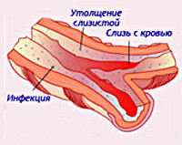 Fibroza chistica - cauze, simptome, diagnostic și tratament