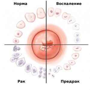 Medicina tradițională și tratament acasă modul de a trata de col uterin eroziune auto