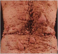 Neurofibromatoza - cauze, tipuri, simptome, tratament, prevenire