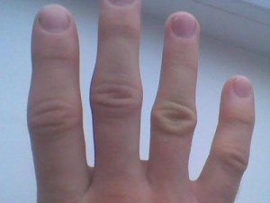 articulații tumefiate în degetele de la mâini cauzele