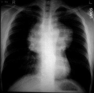 Tumorile simptomelor superior și posterior mediastin, clasificare, cauze, prognosticul și tratamentul