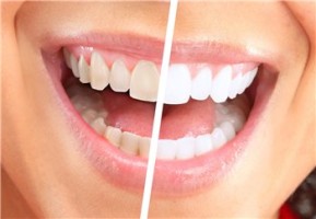 Caracteristici ale dinților fotooxidare