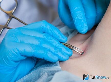 Piercing o selecție transdermic implant site-ul, instruire, îngrijire