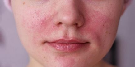 De ce arde fața de femei și bărbați - provoaca inrosirea pielii si boala este posibil