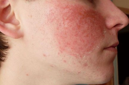 De ce roșu se confruntă cu ce să facă în cazul reddens pielii și arsuri gât