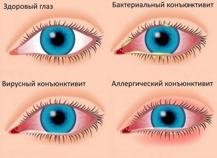 Cauzele și tratamentul ochilor roșii la domiciliu
