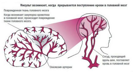 Cauzele de accident vascular cerebral - ca apare din ceea ce se întâmplă la femei, bărbați, tineri