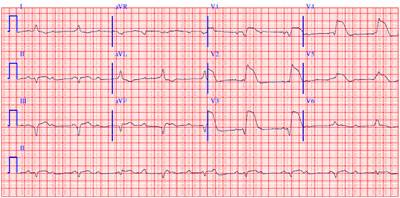 Semne de infarct miocardic (inclusiv severe)