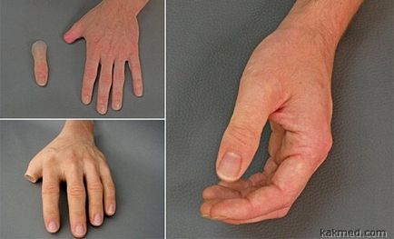 Proteze degete care nu pot fi distinse de cei vii, dezvoltate de designeri din Germania