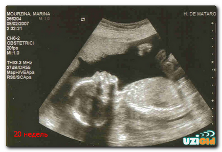 Decodificarea cu ultrasunete în timpul sarcinii abrevierilor, date, mărturie