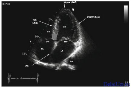 Descifrarea cu ultrasunete inima care arată