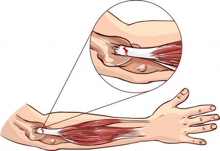 Ruperea simptome musculare și de prim ajutor