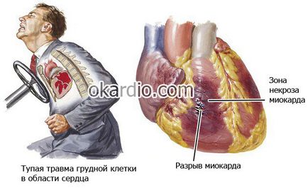 Ruperea inimii cauze, tipuri, simptome și tratament, prognosticul pentru viață