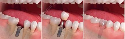 Replantarea salva dacă dintele dislocat