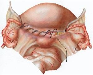 Cicatricea după timpul de vindecare cusătură cezariană, moduri de a elimina