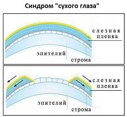 „ochi uscat“ simptome sindrom si tratament, remedii populare în sindromul de ochi uscat