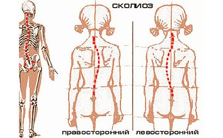 Scolioza la copii cauze, simptome, diagnostic și tratament