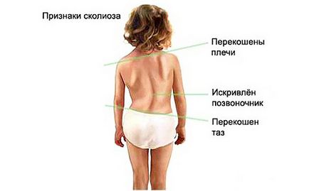 Scolioza la copii cauze, simptome, diagnostic și tratament