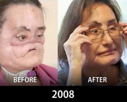 fotografii comparative care arată modul în care transplanturi de fata au venit in 10 ani, umkra
