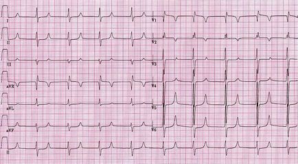 infarct miocardic clasificare etapă, tipuri, forme, tipuri,