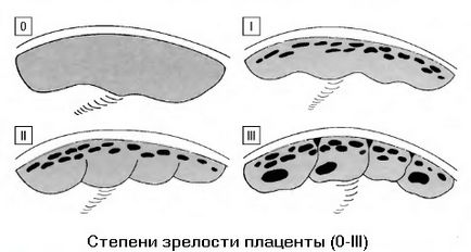 gradul de maturitate a placenta de saptamana - 0, 1, 2, 3