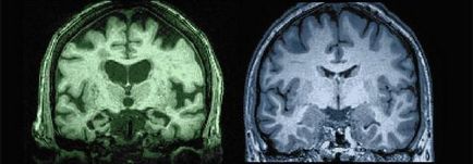 Spatiul subarahnoidian cauze, simptome si diagnostic de extindere - viata mea