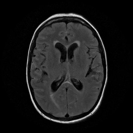 Spatiul subarahnoidian cauze, simptome si diagnostic de extindere - viata mea