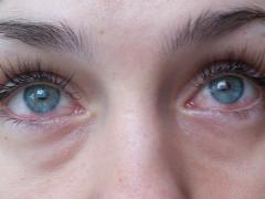 cornee prejudiciu ochi, tratament, simptome si diagnostic