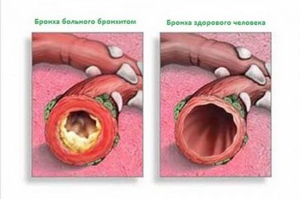 Traheobronsita - forme, cauze, simptome și tratament