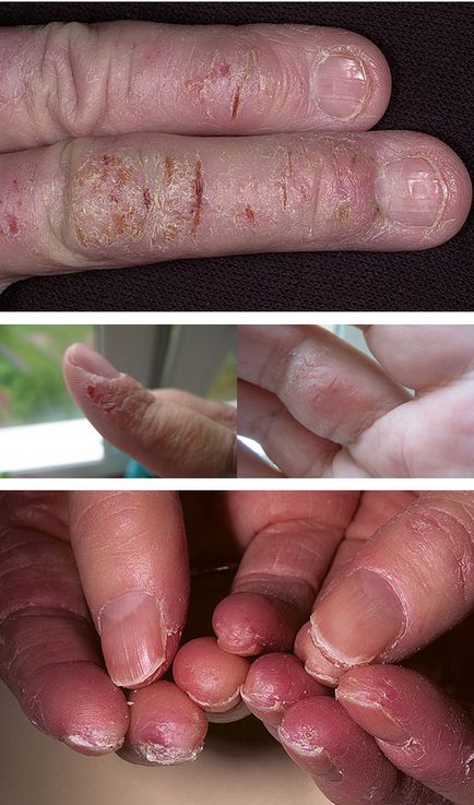 Fisuri în degetele cauzele tratamentului cu unguente, de îngrijire la domiciliu