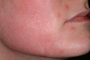 Îngrijire după un peeling chimic facial