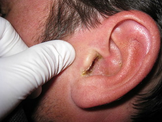 Pierderea auzului congenitale este un risc de pierdere a auzului la nou-nascuti, testul pentru pierderea si tratamentul bolilor de auz
