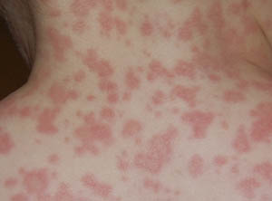 Alergia la amoxicilină