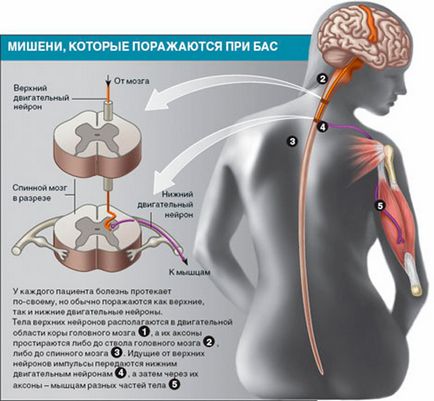 scleroză laterală amiotrofică cauze, simptome, imagine, diagnostic și tratament