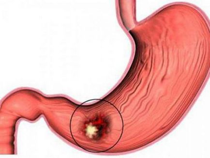 Dureri de stomac de mai sus cauzele principale ombilicului și tratamente