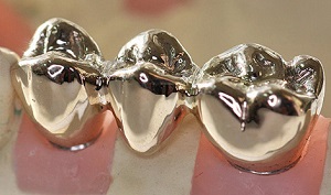 coroane din metal solid pe fabricație și fotografii dinți