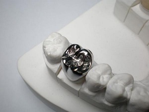coroane din metal solid pe fabricație și fotografii dinți