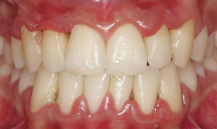 Clåtirea dinților cu inflamarea gingiilor