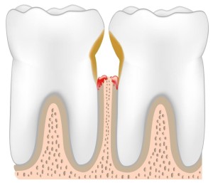 Ce se întâmplă dacă se clatină dinții cum de a consolida și de a salva molarii și produse lactate, întărirea gingiilor