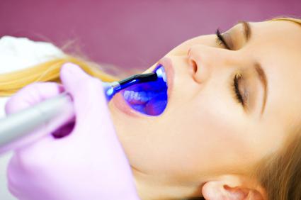 Ce este sigilarea dintilor de etanșare dentare la copii