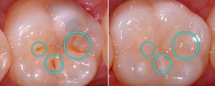 Ce este sigilarea dintilor de etanșare dentare la copii