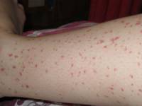 Purpura pe picioare, provoacă la copii și adulți (hemoragică) Purpura pe picioare, provoacă la copii și adulți