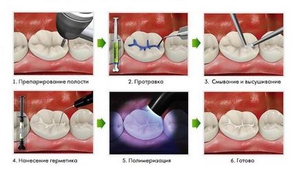 Etanșare (etanșare) fisurarea copii, care este, pret, recenzii (fisuri) Etanșare (etanșare) fisurarea copii, care este, preț, comentarii