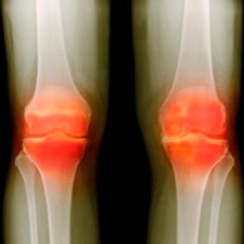 Osteoartrita a genunchiului tratate prin remedii populare