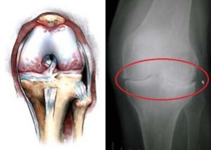 Osteoartrita a genunchiului tratate prin remedii populare