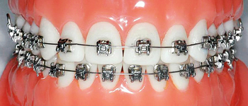 Malocluzie dinților, preturi