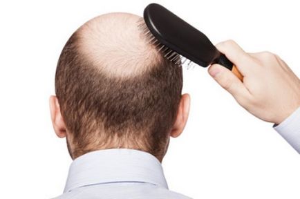 Cum să nu devină chel înainte de vârsta de 7 greșeli în îngrijirea părului pentru bărbați, de sănătate de sex masculin, de sănătate,