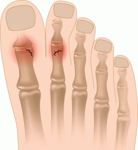 Cum de a determina tipurile de fractură deget de la picior, simptome, diagnostic
