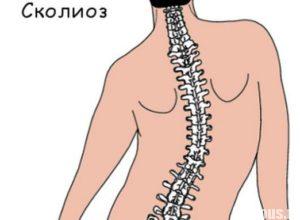 Cum de a determina scolioza acasă metode de diagnostic abateri