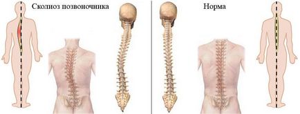 Cum de a determina scolioza acasă metode de diagnostic abateri